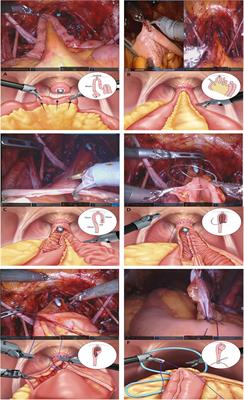 The learning curve for robot-assisted radical cystectomy with total intracorporeal urinary diversion based on radical cystectomy pentafecta